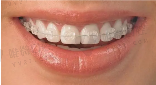 二氧化锆瓷牙是较好的吗（二氧化锆和烤瓷牙的区别）(图1)